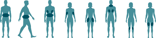 Behandlungszonen Kryolipolyse – Körperzonen Übersicht