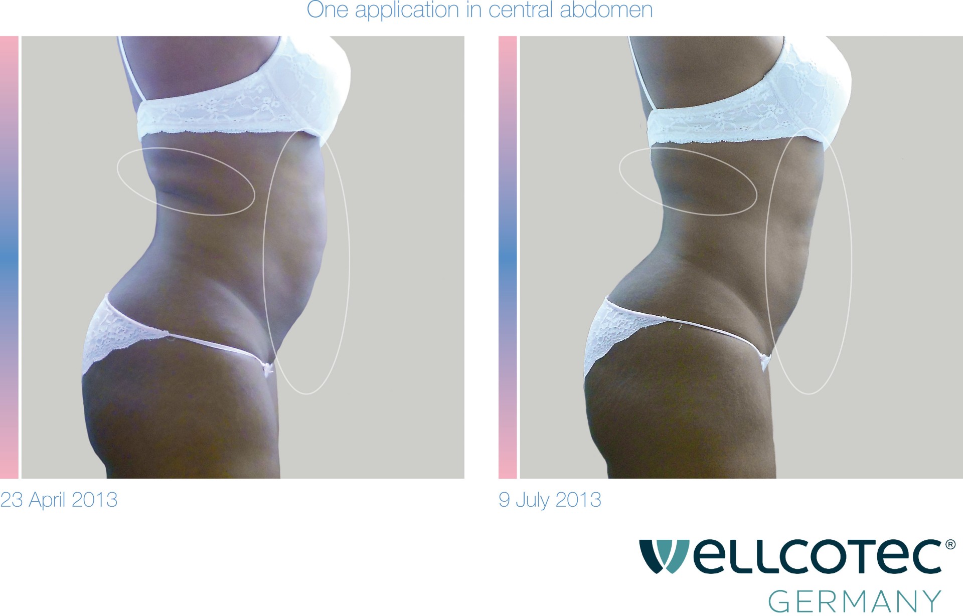 Kryolipolyse Vorher Nachher – Bauch seitlich