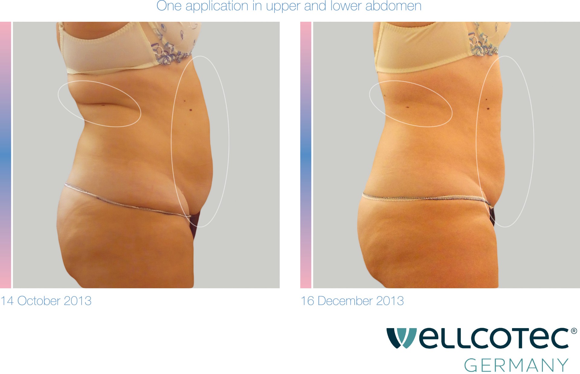 Kryolipolyse Vorher Nachher – Bauch Seite