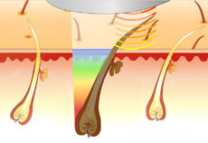 SHR-Diodenlaser Anwendung – Wellcotec Handstück